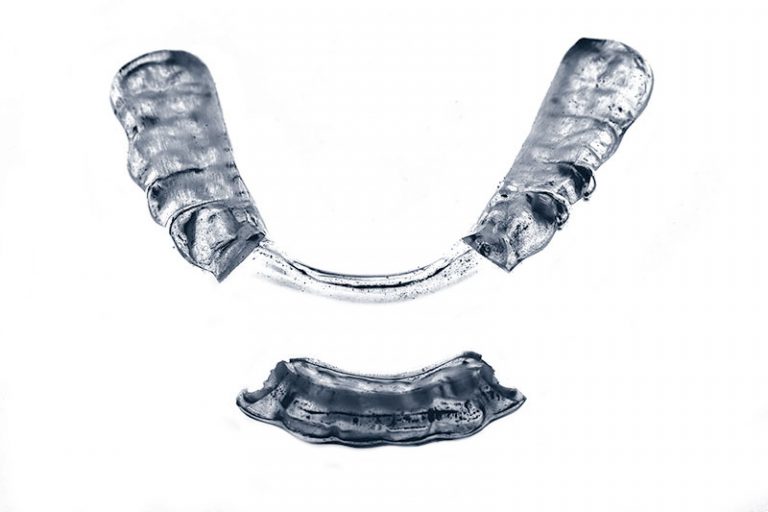 Adjusted CMD splint from dental practice Asamhof in Munich