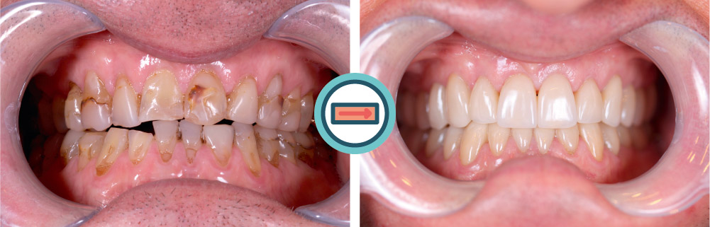 GESAMTREHABILITATION MIT VOLLKERAMIK - Zahnarzt Dr. Muggenthaler München