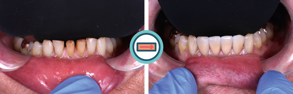 Restauration von 4 Unterkiefer-Frontzähnen mit Keramikveneers