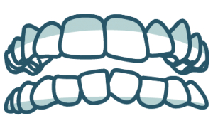 Abbildung eines Zahnengstand des Kiefers - Zahnarzt Muggenthaler München im Asamhof