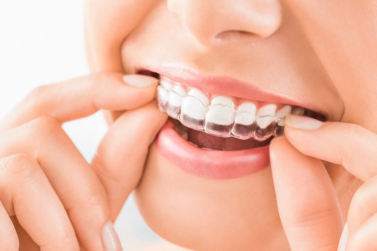 Unsichtbare Zahnspange Invisalign aus Zahnarztpraxis Muggenthaler im Asamhof Münchner Innenstadt